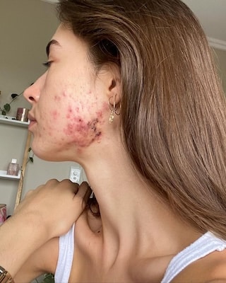 Accepting your acne: Real girls open up about their skincare struggles